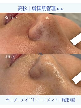オン(on.)/【毛穴】施術一回での変化です♪