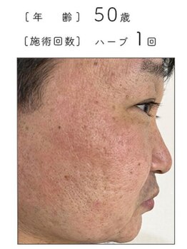 リベル 名古屋(Lebelle:)/ハーブピーリング専門名古屋