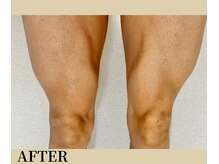 リノ(Lino)/1回の脱毛の効果