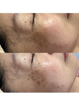 じゅえる/シミケア直後の様子 次へ→