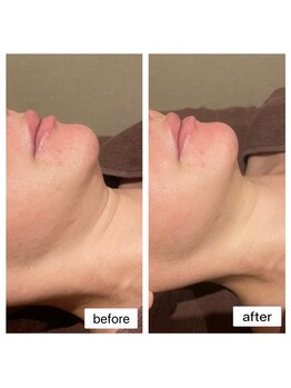 プレジール(PLAISIR)/レモンボトル Before・After