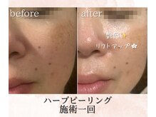 シェリール(cherir)/ハーブピーリング