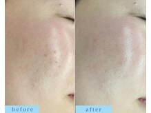 アフロディーテ(APHRODITE)/ビフォーアフター