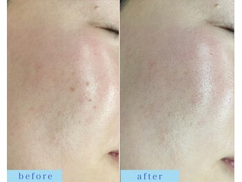 アフロディーテ(APHRODITE)/ビフォーアフター