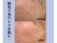 浜松富塚ベルミーランド/脱毛BEFORE→AFTER