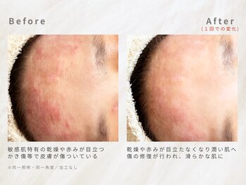 メレ(mele)/20代赤み/ニキビケア・毛穴