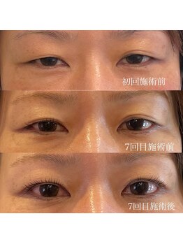 アルティ バイ ドルチェ(Ulti by dolce)/ダブルアイリフト♪