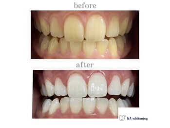 エヌエーホワイトニング たまプラーザ店(NAホワイトニング)/ビフォーアフター