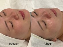 トム(Thom)/肌くすみにはハーブピーリング♪