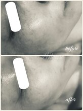 エルール トータルビューティ(Aileure total beauty)/インディバ×ララピール