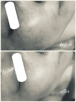 エルール トータルビューティ(Aileure total beauty)/インディバ×ララピール