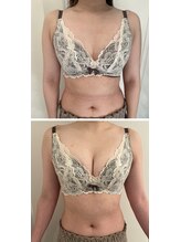 美人バスト 本厚木店/バストアップ◇症例◇