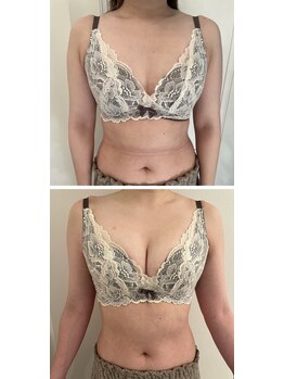 美人バスト 本厚木店/バストアップ◇症例◇