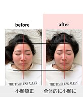 蓮 那珂市/全体的にあがり小顔に