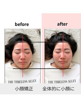 蓮 那珂市/全体的にあがり小顔に