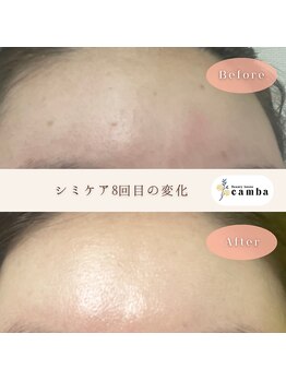 カンバ(camba)/【シミケア】Before→after