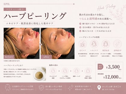 エピル(EPIL)の写真