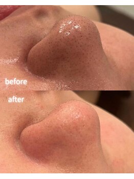 リルビー(Lilby)の写真/感動の艶肌へ。フェイシャルワックスで毛穴汚れや産毛をスッキリ。施術直後から驚きのつるすべ肌に！