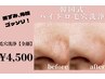【ニキビ/黒ずみケアにオススメ】毛穴洗浄◎全顔75分 ¥7,700→¥4500