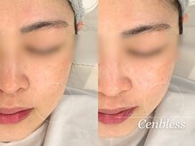 ビューティスタジオ センブレス(Cenbless)/【プラズマ フェイシャル】