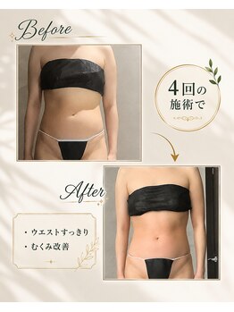 リンガ(Ringa)/腸活ケアで実感すっきり変化