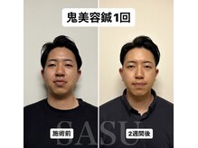 サス(SASU)/鬼美容鍼1ヶ月後の変化☆