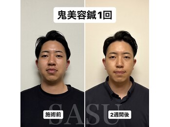 サス(SASU)/鬼美容鍼1ヶ月後の変化☆