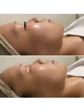 コルギ デ コガオ(KORUGI de KOGAO)/本気の超小顔肌管理プラズマUDM