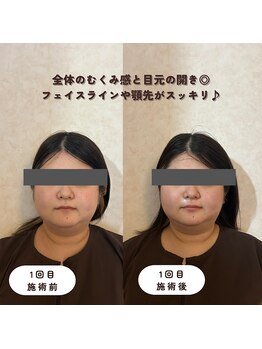 ウーマンビーヘルス(woman Be Health)/オーダーメイド美容鍼灸90分1回