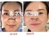年齢肌の本気改善＋水光肌！ダイヤモンドピール＋ルネセル基礎7点！