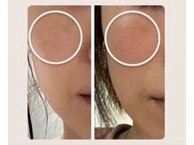 リバイセリー(Revicelly)の雰囲気（レーザーでも反応しない薄いシミにも効果あり◎）