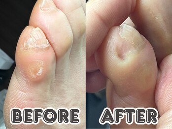 ポドロ ウィズ ニコルル 大阪天満店(PoDoLo with Nicolulu)/【小指の爪】フットケア大阪