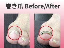 スロース鍼灸整体院(SLOTH鍼灸整体院)/巻き爪の改善例