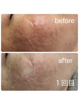 スキンラボ カホクカイ(KaHokuKai)/初回　