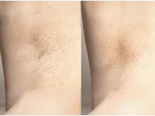 サロンミー(salon Mii)/メンズ　ワキ脱毛