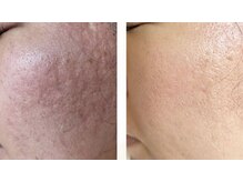 エクセレントビューティーサロン 艶(EN)/ニキビによる凸凹肌毛穴改善