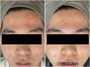 レイズ(RAISE)/当店人気No.1水光ピーリング