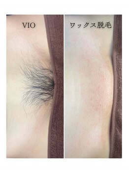 ワックスピスト(WAXPIST)の写真/【VIO脱毛が初めての方も◎】効率よくキレイにムダ毛を減らすならサロン脱毛！完全個室×女性スタッフ対応!