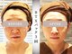 モルティー 広島店(Molti)の写真/【たるみ小じわ・肌ハリ改善サロン】ハリと弾力を取り戻すBT-Xパックが凄い！将来のたるみ予防にも効果的◎