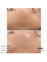 シェルビー(Cielbe.)/生コラーゲンエステ