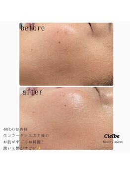 シェルビー(Cielbe.)/生コラーゲンエステ