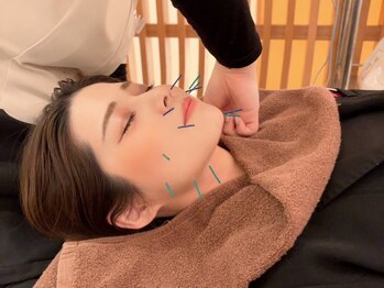 シンキュウ(SHIN9)の写真/≪電気美容鍼（30本）40分◆初回¥5500～≫SHIN9だからこそできる美容鍼★効果に自信アリ！理想の小顔に◎
