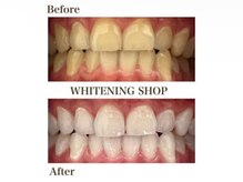 ホワイトニングショップ 米子店の雰囲気（簡単スピーディーなセルフホワイトニング）