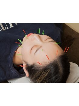 鍼灸施術を受けたい