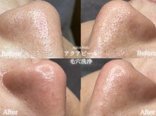 リル 和歌山市店(lilou)/韓国肌管理セットで毛穴ケア♪