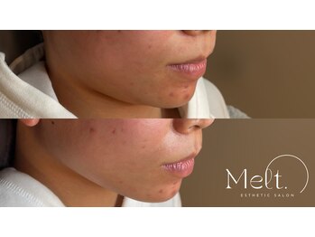 メルト 中目黒(Melt.)/*サーマジェン顎下