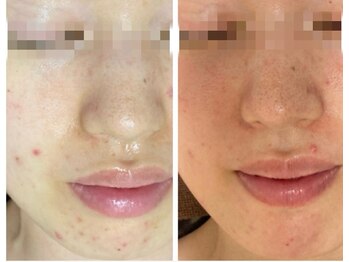 ルナート(Lunart)/ハーブピーリング【顔】ニキビ悩