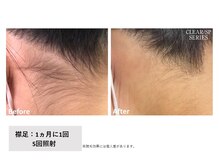 ユーセレクト ビューティー プラス(U-SELECT BEAUTY PLUS)/うなじ スッキリ美肌になろう！