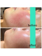 フェリーチェ(felice)/お顔の赤み改善＆予防