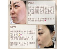 ノーブル 新宿南口(NOBLE)/ダウンタイムの様子